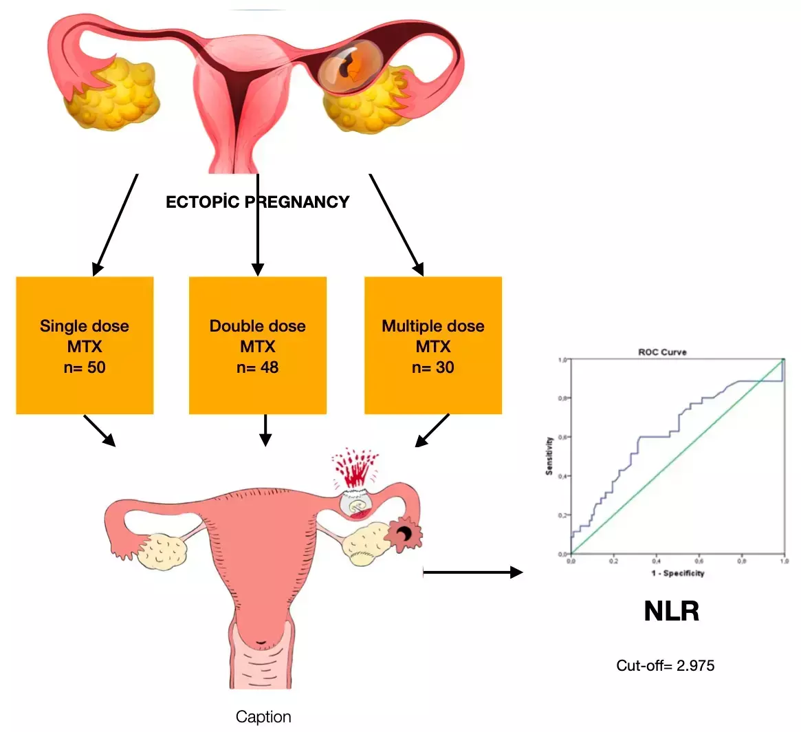 Higher gravidity andcbeta HCG levels may Predict Methotrexate Failure in tubal Ectopic Pregnancy: Study