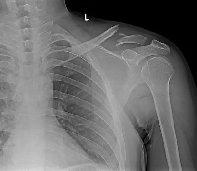 Robot-assisted retrograde elastic intramedullary nailing safe and minimally invasive treatment for displaced midshaft clavicular fractures: study