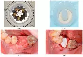 Chlorhexidine and hydrogen peroxide Effective socket Irrigation Solutions for Mandibular Third Molar Surgery: Study