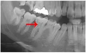 Dental Radiographs effective in Detecting Pulp Stones,  suggests study