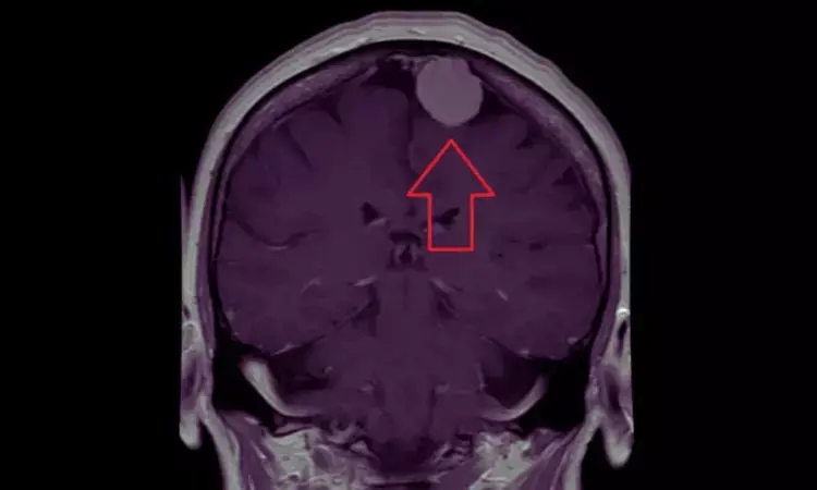 Preoperative Oedema Strongly Linked to Seizure Risk in Meningioma Patients: Meta-Analysis Findings