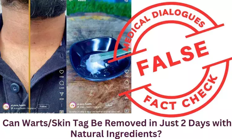 Fact Check: Can Warts/Skin Tag Be Removed in Just 2 Days with Natural Ingredients?