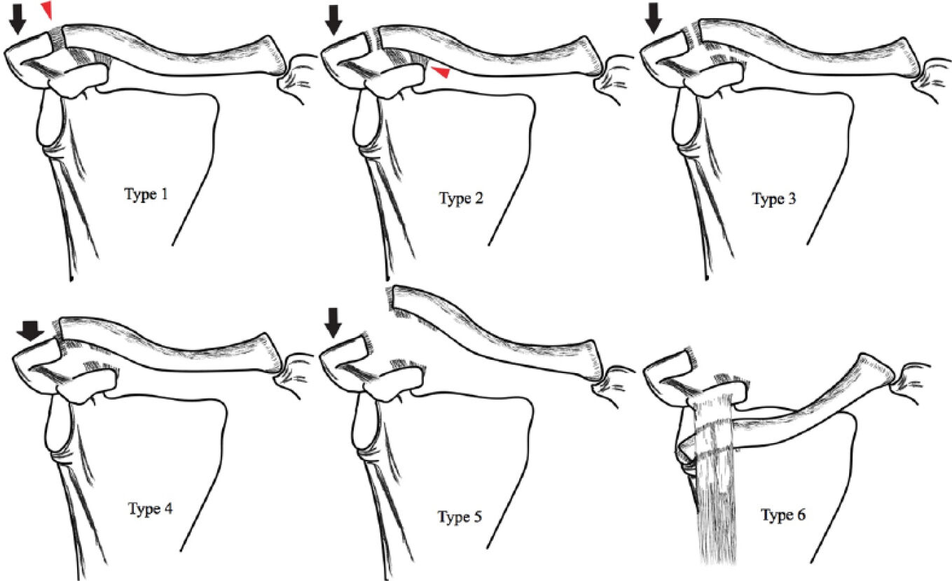 Acromioclavicular joint injuries Isolated midshaft clavicle fractures ...