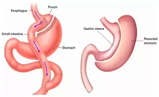 Sleeve gastrectomy also significantly improves respiratory function and Physical activity of individuals with obesity, suggests study