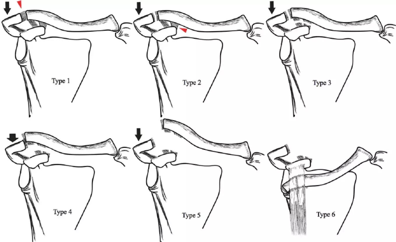 Acromioclavicular joint  injuries  Isolated midshaft clavicle fractures Injuries: Challenges and Considerations