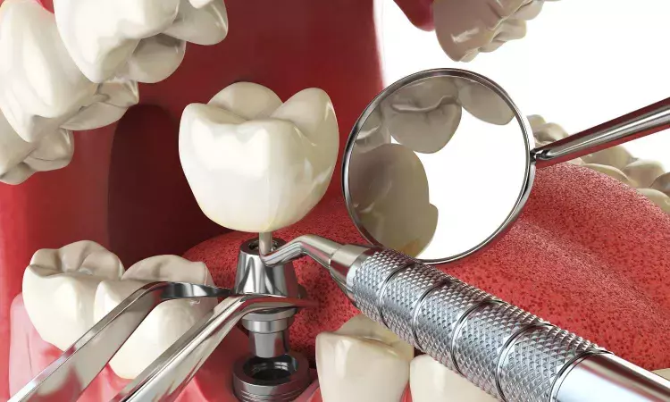 Dental implants still functional after forty years,  reports research