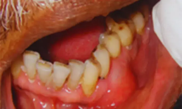 Unusual Presentation of Lateral Periodontal Cyst in Molar Region of Elderly Patient