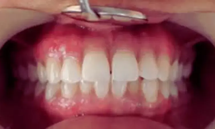 Indian Case Study Supports Liquid Nitrogen as a Safe and Painless Gingival Depigmentation Technique