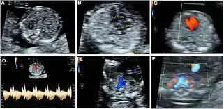 First-Trimester Ultrasound Effective  for Screening for Fetal CHD, suggests study