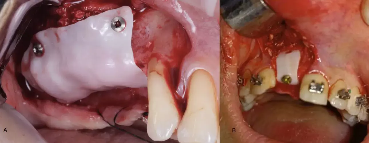 Customized Zirconia Membranes effective for Alveolar Ridge Augmentation: A systematic review