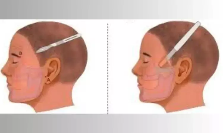 Modified Temporal Hairline Approach Enhances Zygomatic Arch Fracture Repair, reports research