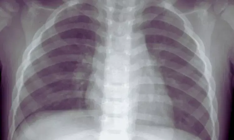 Chest X-Ray Findings May Help Detect Drug-Resistant TB Early in Children, Study Suggests