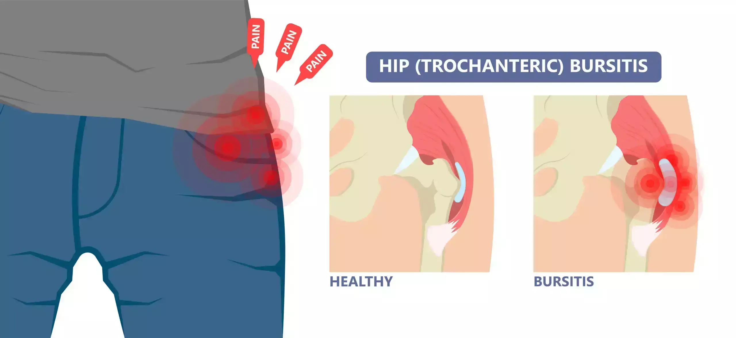 Can Platelet-Rich Plasma Ease Greater Trochanteric Pain?