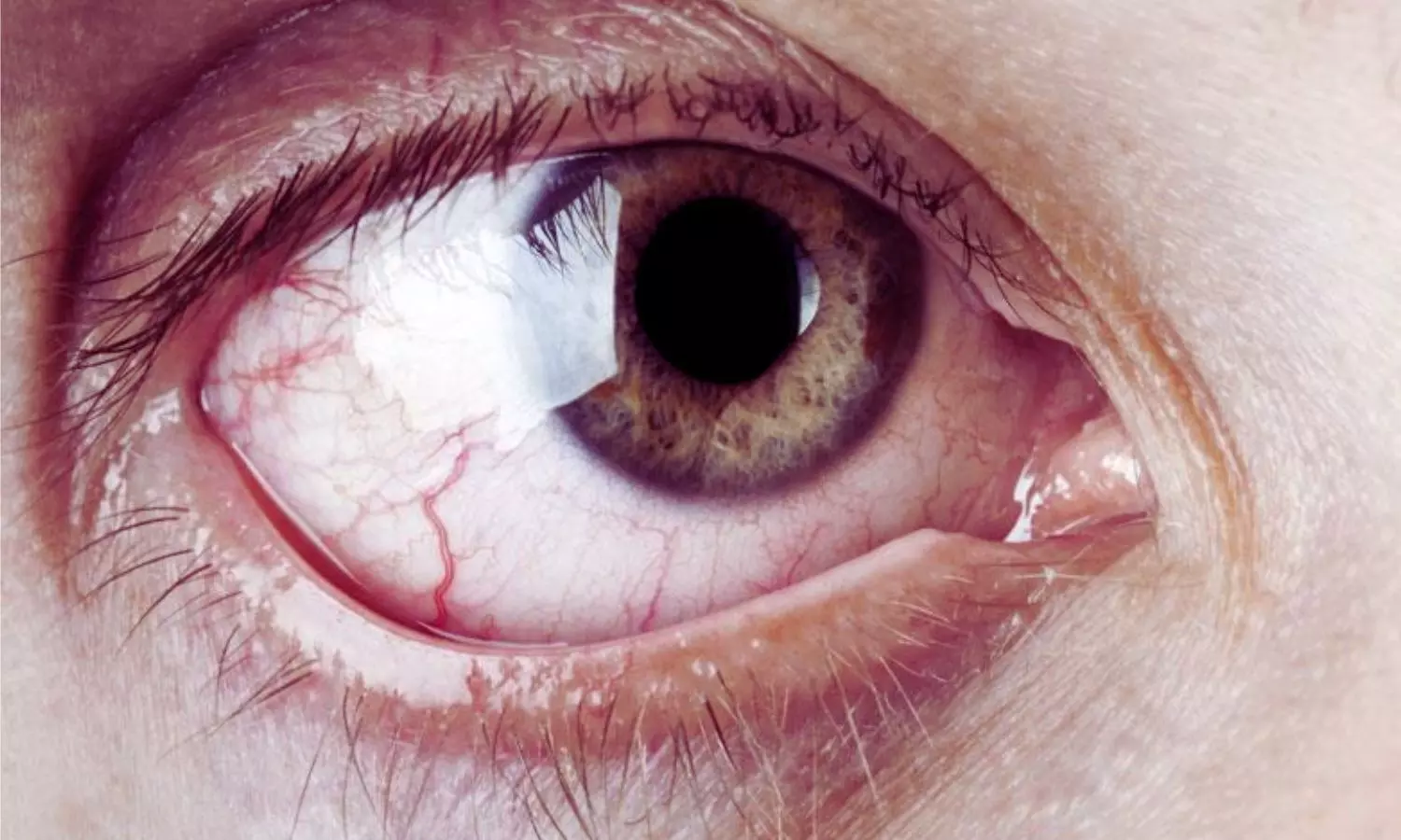 Dexmedetomidine Enhances Onset and Prolongs Peribulbar Block in Eye Surgery: Systematic Review Dexmedetomidine Enhances Onset and Prolongs Peribulbar Block in Eye Surgery: Systematic Review