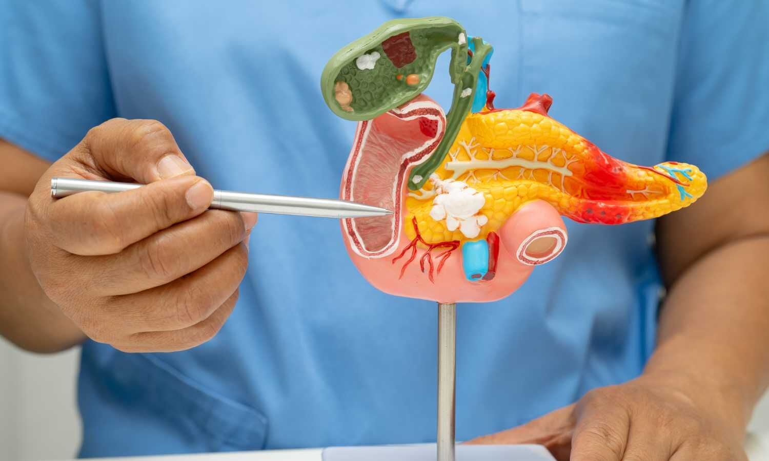 ERCP With Minor Papillotomy Fails to Prevent Recurrent Pancreatitis: JAMA