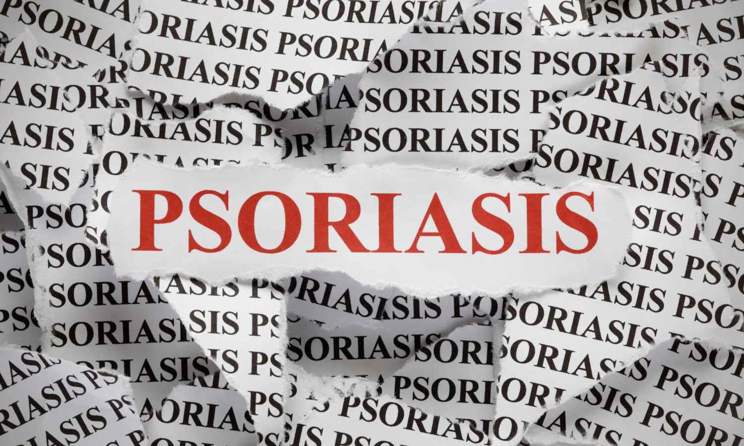 New gene discovery paves way for tailored psoriasis treatments,  reveals research