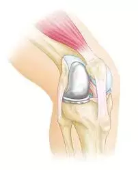 Study evaluates Different Pain Management Approaches After Knee Replacement Surgery