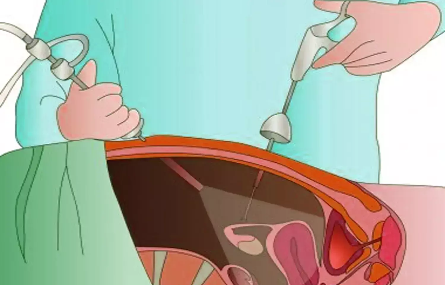 Laparoscopic Supracervical has Lower Postoperative Risks in Uterine Fibroid Surgery vs Total Hysterectomy: Study Laparoscopic Supracervical has Lower Postoperative Risks in Uterine Fibroid Surgery vs Total Hysterectomy: Study