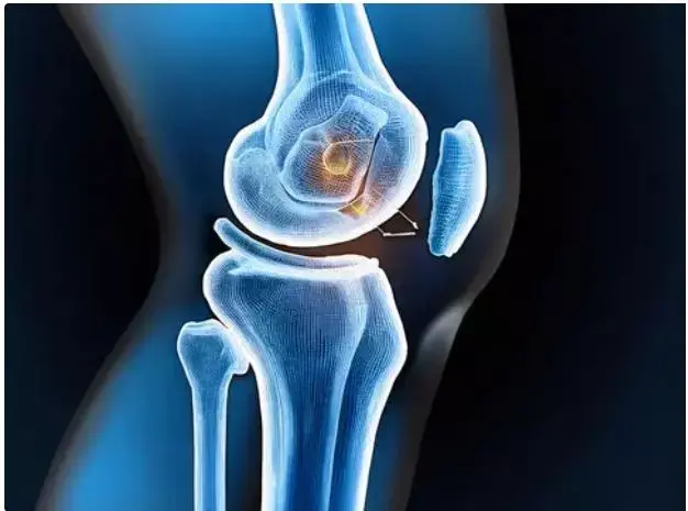 Adductor Canal Block Plus iPACK Enhances Recovery After Knee Replacement: Reveals Study