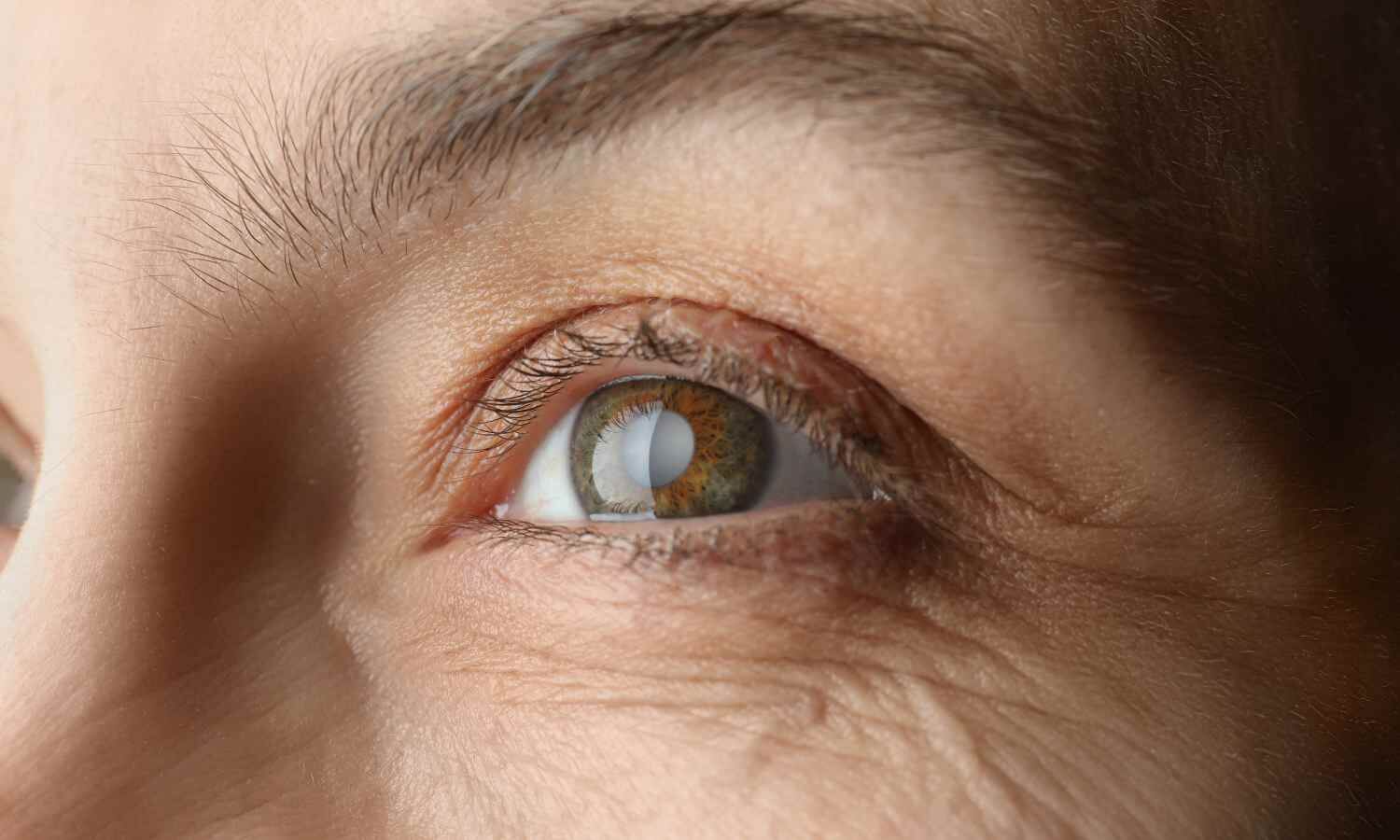 GLP-1 Receptor Agonists May Reduce Risk of Glaucoma: Study