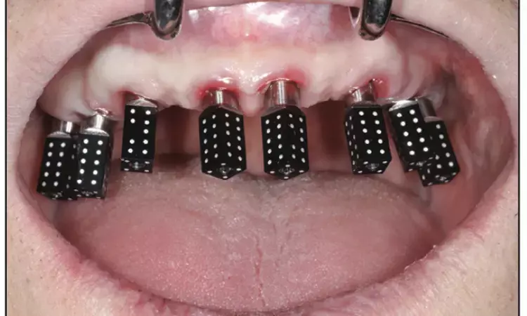 Photogrammetric Systems Outperform Traditional and Intraoral Methods in Impression Accuracy in full-arch dental implant rehabilitation: Study