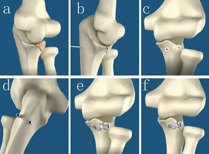 Suture Lasso and Lateral Plate combo Effective Treatment for Transolecranon Fracture-Dislocations : Study Suture Lasso and Lateral Plate combo Effective Treatment for Transolecranon Fracture-Dislocations : Study