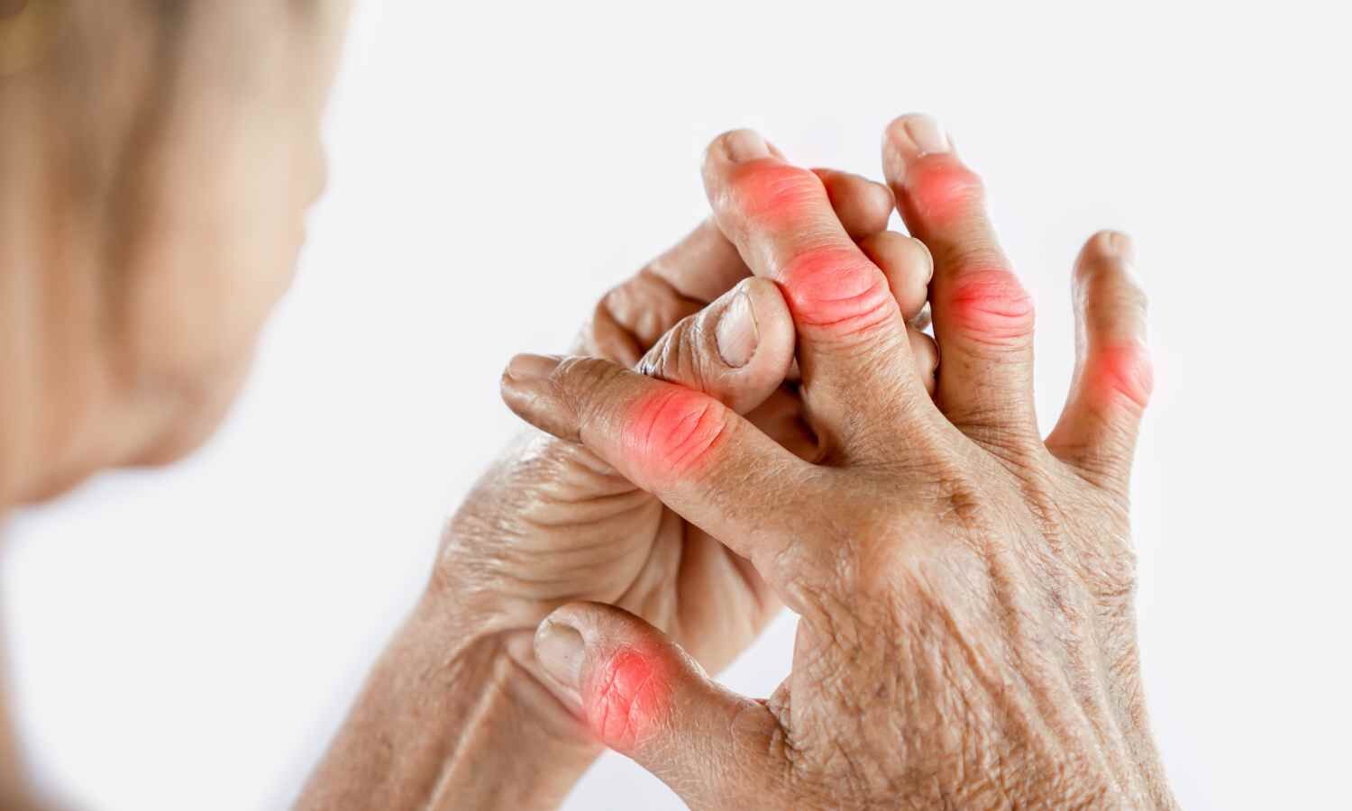 Febuxostat Effectively Lowers Uric Acid in Gout Regardless of Renal Function: Study
