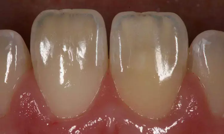 Background Colour and Coping Thickness Key to Zirconia Veneer Shade Accuracy: Study