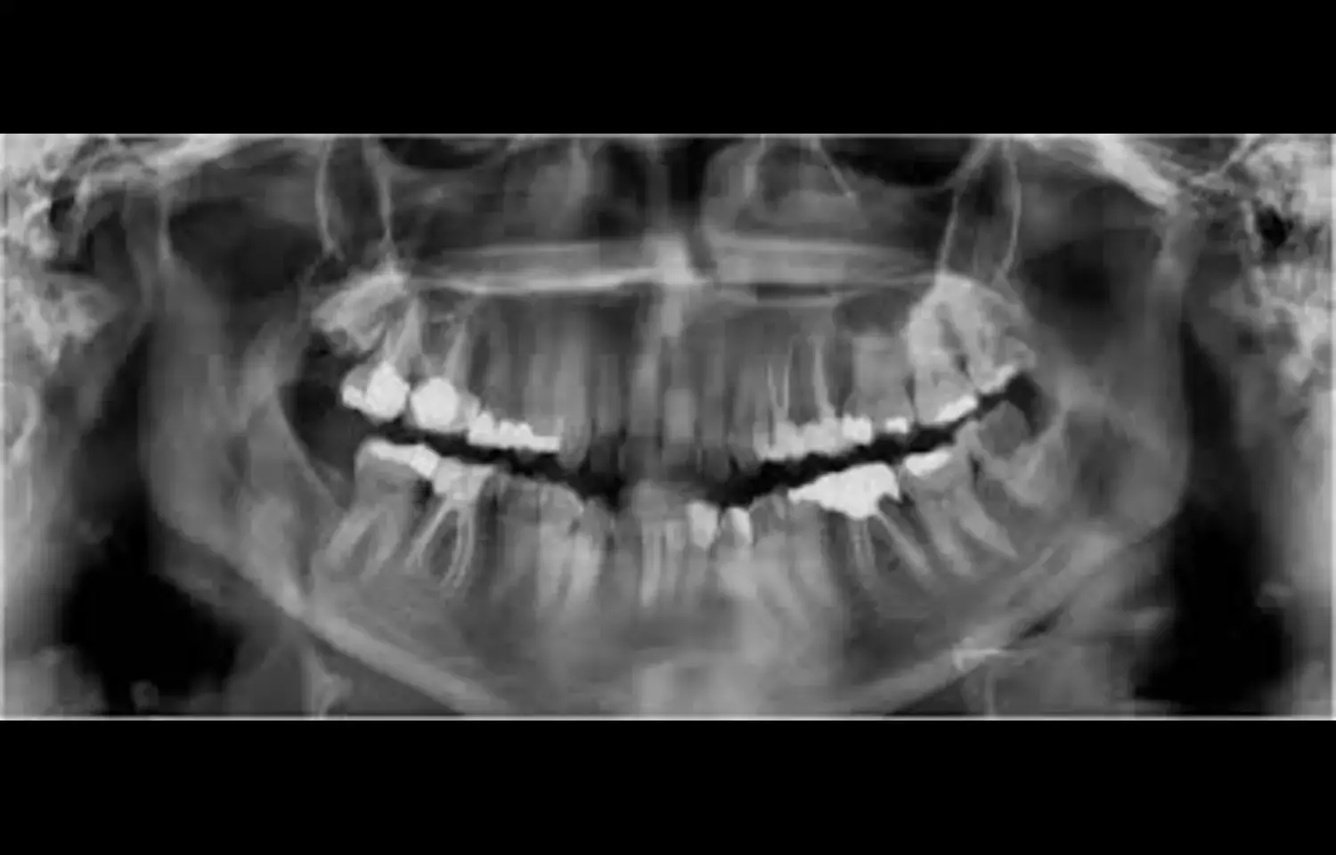 Higher Rates of Carotid Artery Calcification and Pulp Stones Found in Diabetics: Study