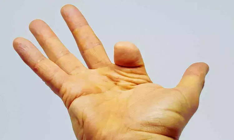 Toe transfer surgery may improve outcomes after finger amputation,  reveals study