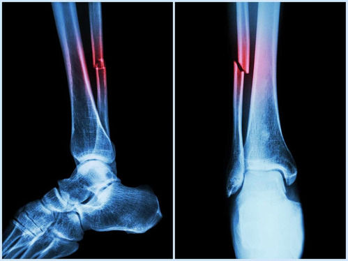 GLP-1 Receptor Agonists linked to modest reduction of risk of Femur Fracture: Study
