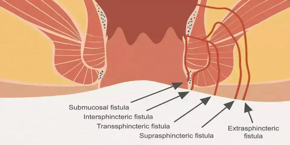 Pancreatic Guidewire-Assisted Fistulotomy Boosts Success in Difficult Biliary Cannulation: Study Pancreatic Guidewire-Assisted Fistulotomy Boosts Success in Difficult Biliary Cannulation: Study