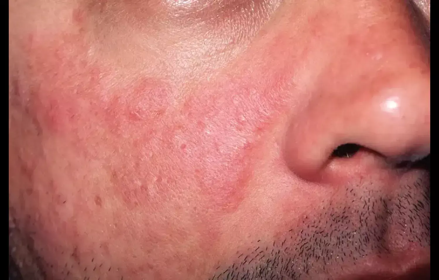 Falls Common Among Lupus Patients, Linked to Multiple Risk Factors: Study