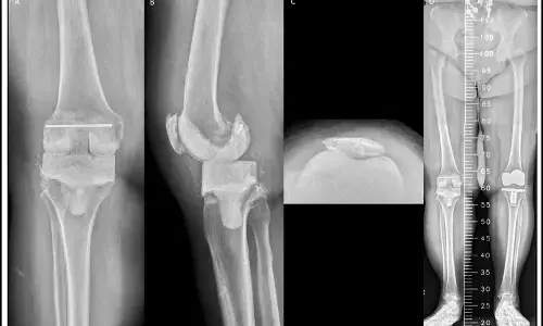 Type 2 Diabetes Raises Mortality but Not Reoperation After Hip and Knee Replacement: Study