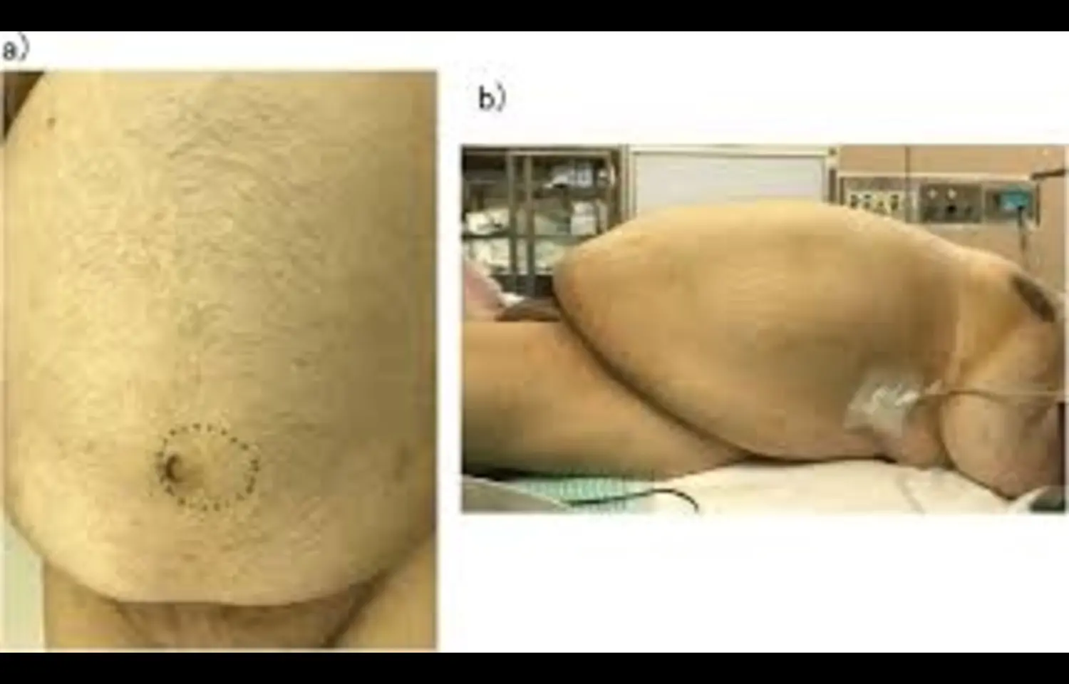 Mesh Weight of 45–60 g/m² Minimises Reoperation Risk in Laparoscopic Inguinal Hernia Repair: JAMA