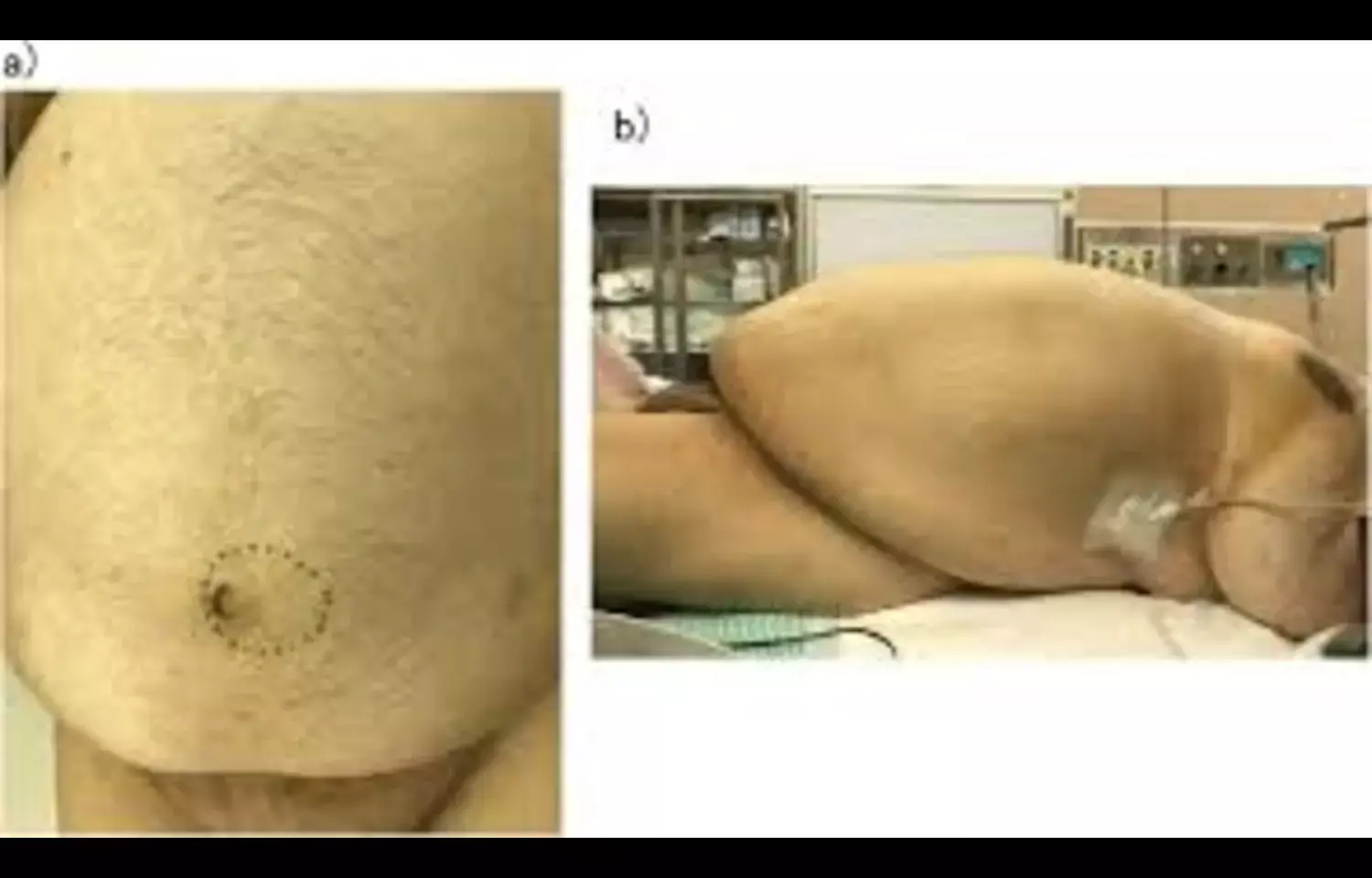 Mesh Weight of 45–60 g/m² Minimises Reoperation Risk in Laparoscopic Inguinal Hernia Repair: JAMA Mesh Weight of 45–60 g/m² Minimises Reoperation Risk in Laparoscopic Inguinal Hernia Repair: JAMA