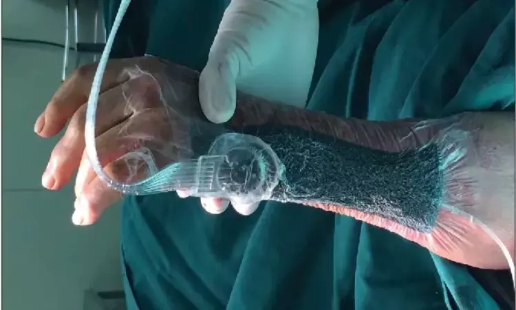 Vacuum Sealing Drainage Enhances Recovery in Severe Fournier’s Gangrene Cases: Study Vacuum Sealing Drainage Enhances Recovery in Severe Fournier’s Gangrene Cases: Study