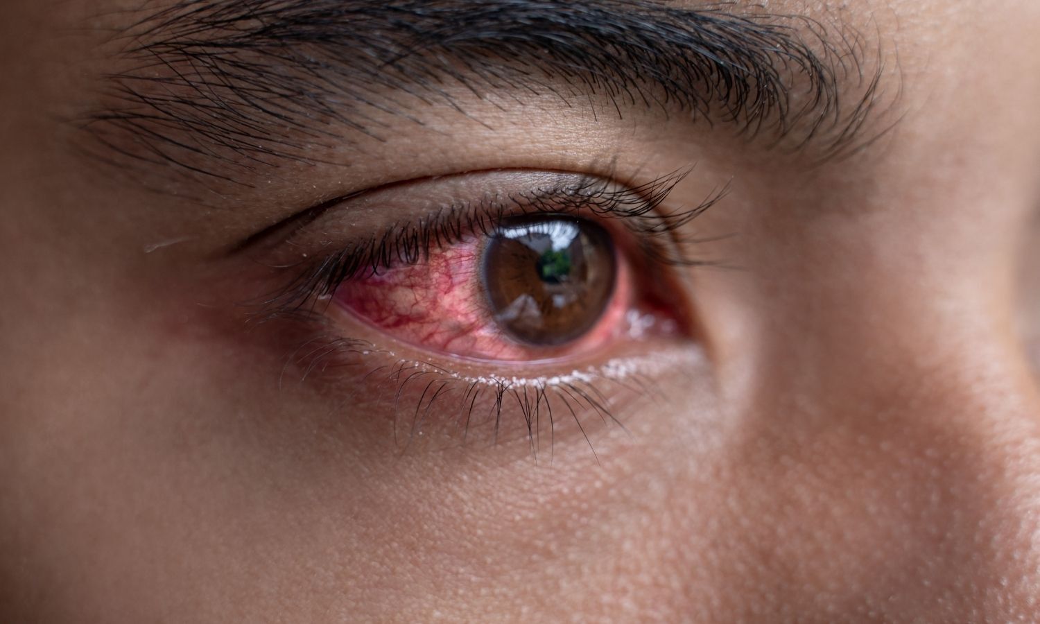 Allergic Conjunctivitis tied to Increased Corneal Disease Risk: Study