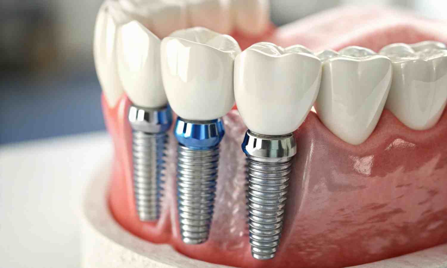 Guided Surgery Enhances Accuracy of Immediate dental Implant Placement, finds study