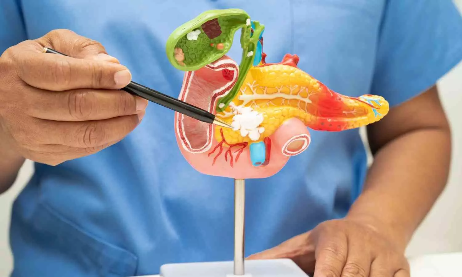 High Intake of Dietary Advanced Glycation End Products Nearly Doubles Gallstone Disease Risk, Suggests Study High Intake of Dietary Advanced Glycation End Products Nearly Doubles Gallstone Disease Risk, Suggests Study