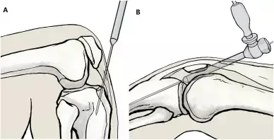 Supra-patellar Approach Superior to Infra-patellar for Extra-articular Tibial Fractures — Study