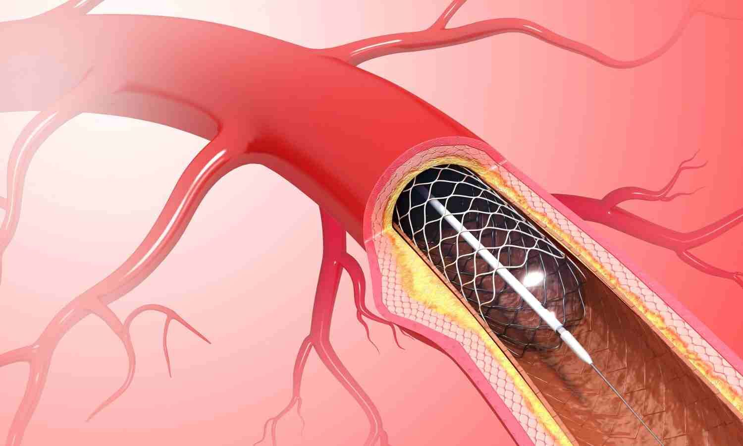 Studies confirm that drug-coated balloons can replace stents – even in larger coronary arteries