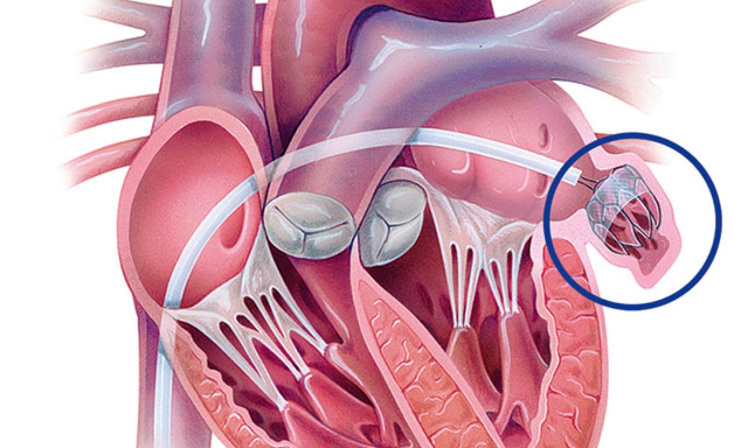 Novel LAA Closure Device Lesifter Promising for Stroke Prevention in Atrial Fibrillation Patients: Study