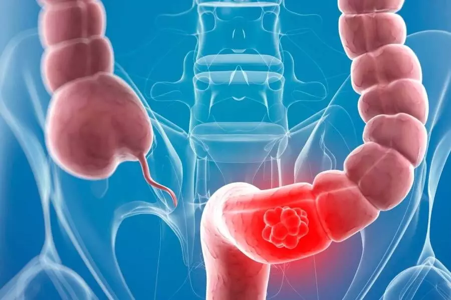 Cephalosporin-Based Prophylaxis: New Evidence Reveals Superior Outcomes After Colorectal Surgery