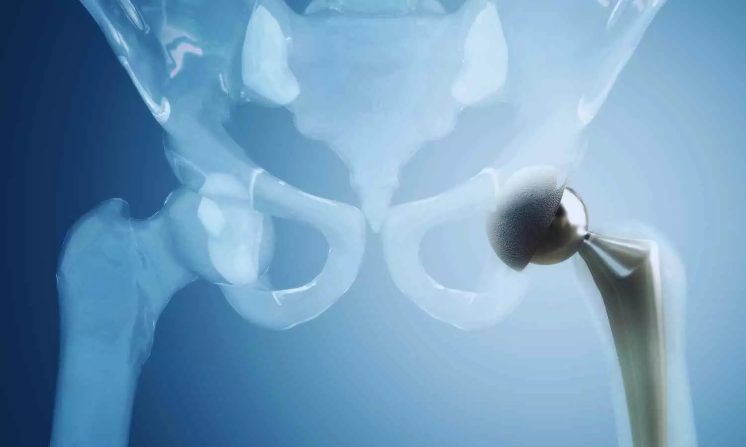 Cemented Total Hip Arthroplasty Shows Favorable Short-Term Outcomes: Study Cemented Total Hip Arthroplasty Shows Favorable Short-Term Outcomes: Study