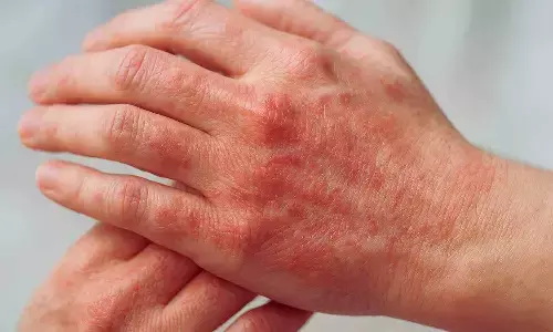 Tralokinumab Shows Sustained Efficacy in Hand Atopic Dermatitis: Study Tralokinumab Shows Sustained Efficacy in Hand Atopic Dermatitis: Study