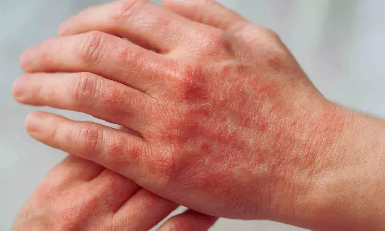 Tralokinumab Shows Sustained Efficacy in Hand Atopic Dermatitis: Study