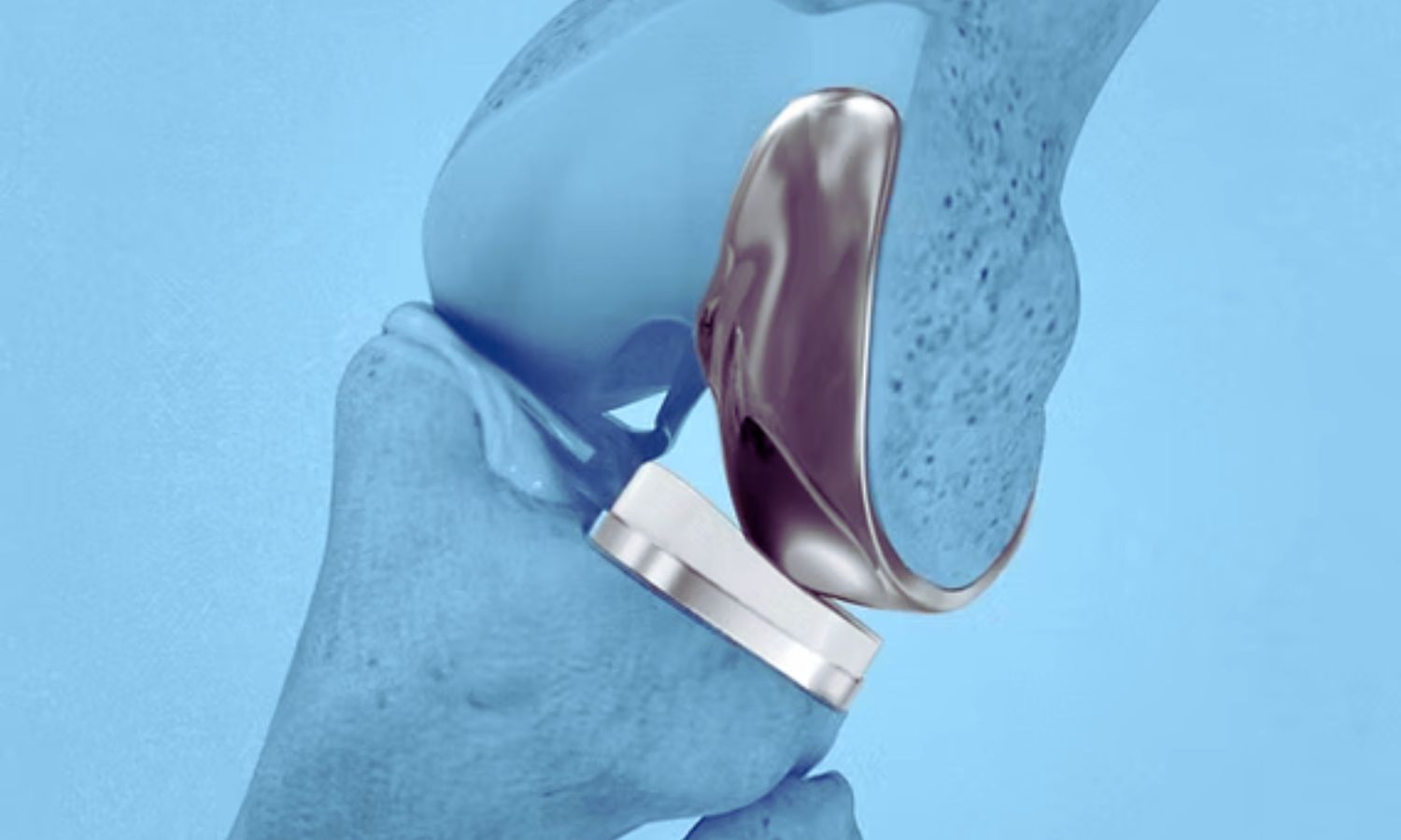 New research links testosterone therapy with serious health risks after total knee replacement surgery