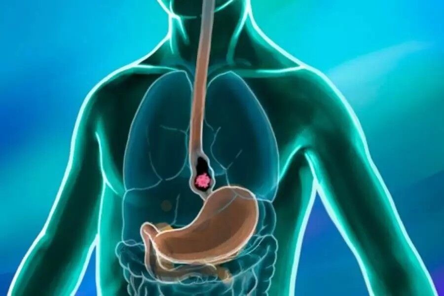 Metformin Linked to Lower Esophageal Cancer Risk: JAMA