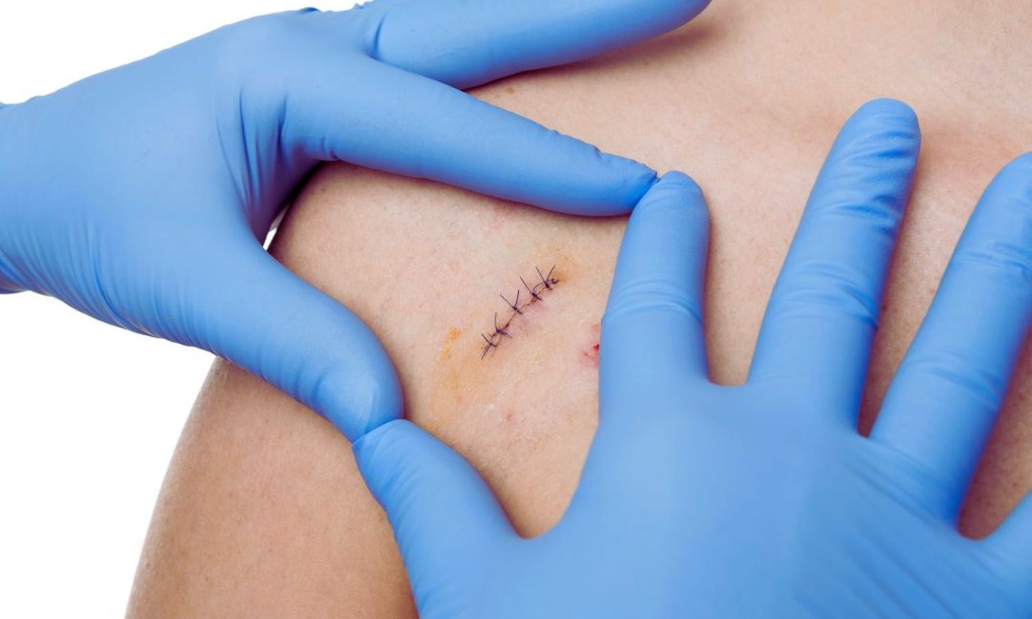 Statins Show Promise in Wound Healing, Reveals Research